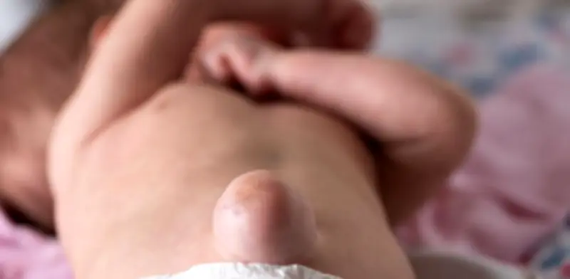 Hernia Umbilical en Bebés: Qué Es, Síntomas y Cuándo Preocuparse