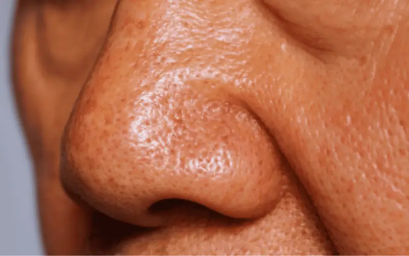 IMSS advierte sobre el síndrome de nariz vacía: olor fétido y pérdida de olfato