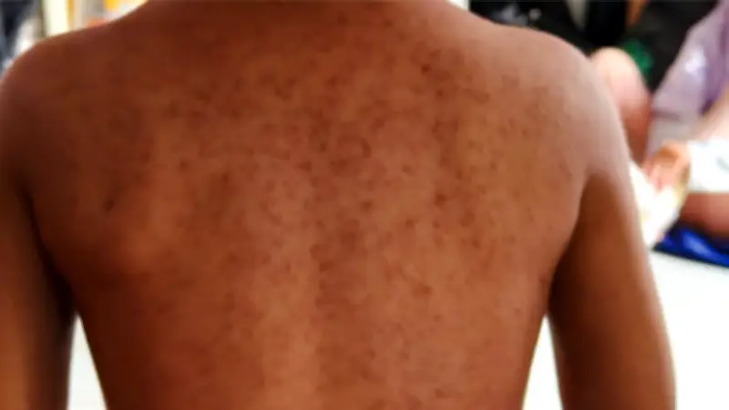 Jalisco reporta 105 nuevos casos de sarampión en un día; acumulado supera los 4 mil contagios