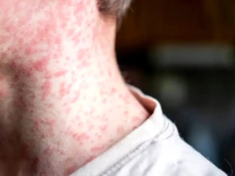 Jalisco reporta reducción significativa en contagios de sarampión y supera 2.5 millones de vacunas aplicadas