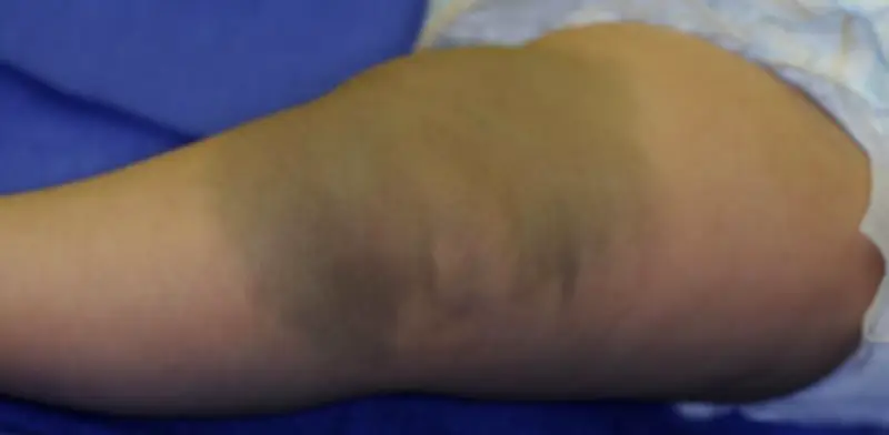Mancha azul en recién nacidos: ¿Moretón o marca de nacimiento benigna?