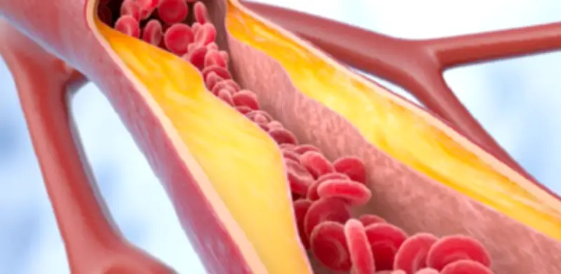 Nueva píldora de MSD reduce colesterol LDL hasta 65% en estudios de fase 3