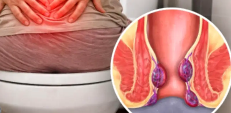 Picazón o dolor al evacuar: Hemorroides, causas y prevención explicadas
