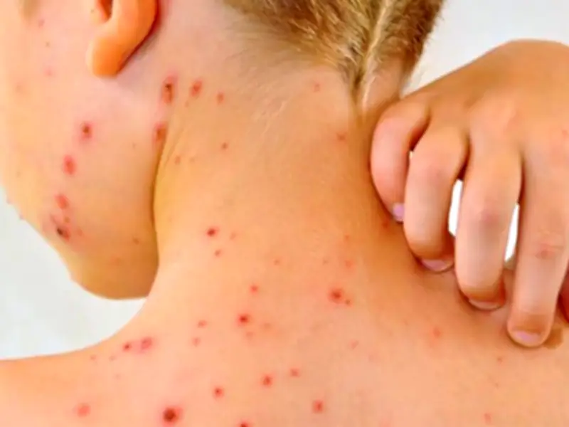 San Luis Potosí reporta nuevo caso de Covid-19 en adulta mayor sin vacunar