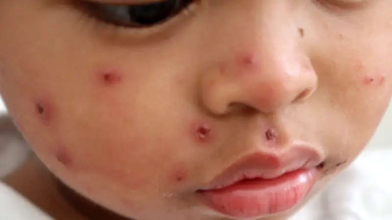 Sarampión en México: 6,511 casos en 2026 superan total de 2025, con 34 muertes acumuladas