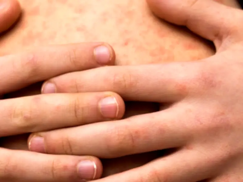 Sarampión resurge en México tras décadas de control: más de 11 mil casos en 2025-2026