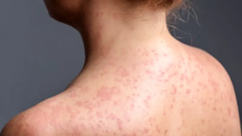 Sinaloa confirma su primera muerte por sarampión; México suma 34 fallecimientos