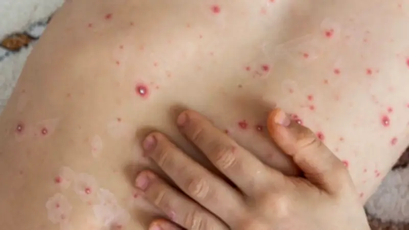 UNAM advierte: virus de la varicela puede reactivarse y causar herpes zóster en adultos