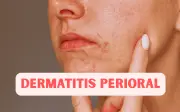 Dermatitis Perioral: ¿Qué son esos granitos alrededor de tu boca?