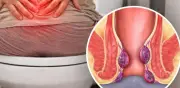 Picazón o dolor al evacuar: Hemorroides, causas y prevención explicadas