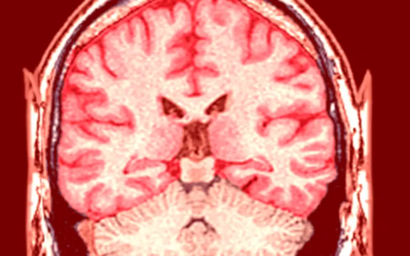 Infartos cerebrales en adultos jóvenes: la crisis silenciosa que crece en México