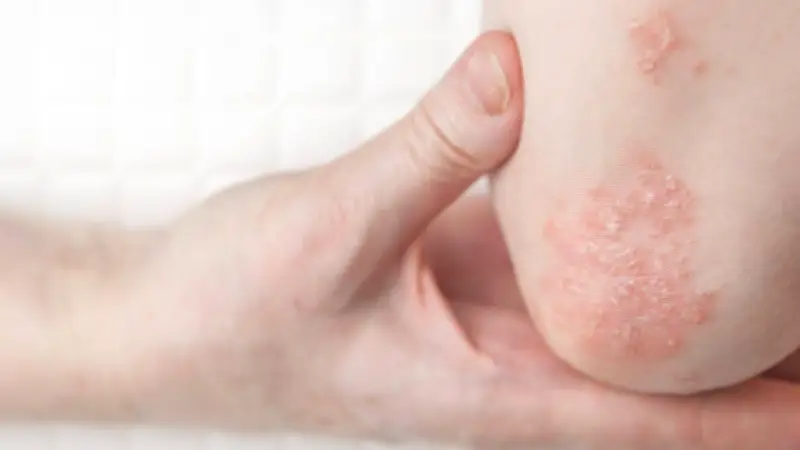 Lupus y psoriasis elevan riesgo de cáncer en un 32% según estudio italiano