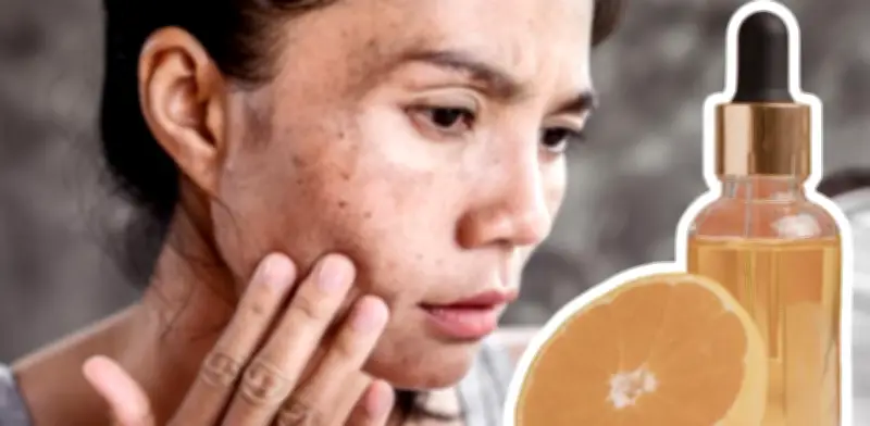 Vitamina C: El aliado dermatológico para combatir manchas oscuras en el rostro