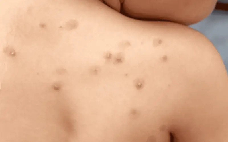 Yucatán registra cuarto caso de viruela símica en 2026; autoridades refuerzan vigilancia