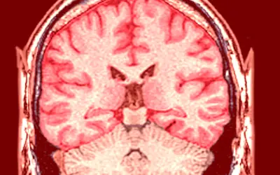 Infartos cerebrales en adultos jóvenes: la crisis silenciosa que crece en México