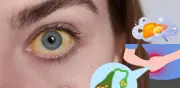 Ojos amarillos: señal de alerta sobre problemas hepáticos y biliares que no debes ignorar