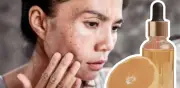 Vitamina C: El aliado dermatológico para combatir manchas oscuras en el rostro