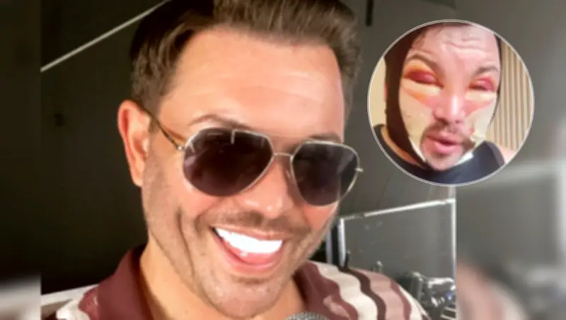 Bobby Norris impacta tras cirugía facial y enfrenta críticas