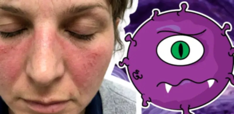 Lupus en mujeres: causas, síntomas y cómo detectarlo a tiempo