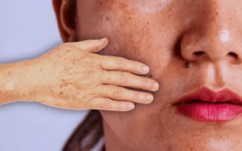 Pecas y manchas: ¿cuándo preocuparte? Guía ABCDE para tu piel