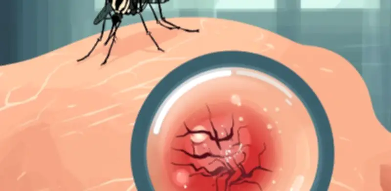Piquete de mosquito peligroso: señales de alerta médica