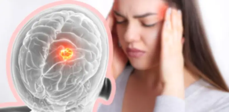 Dolor de cabeza: ¿cuándo puede ser síntoma de tumor cerebral?